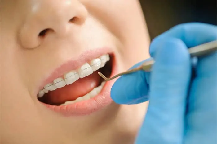 Ceramic Braces by Dr. Basel Mofti, Orthodontist in Dubai