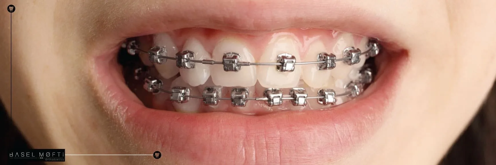 Damon Braces in Dubai