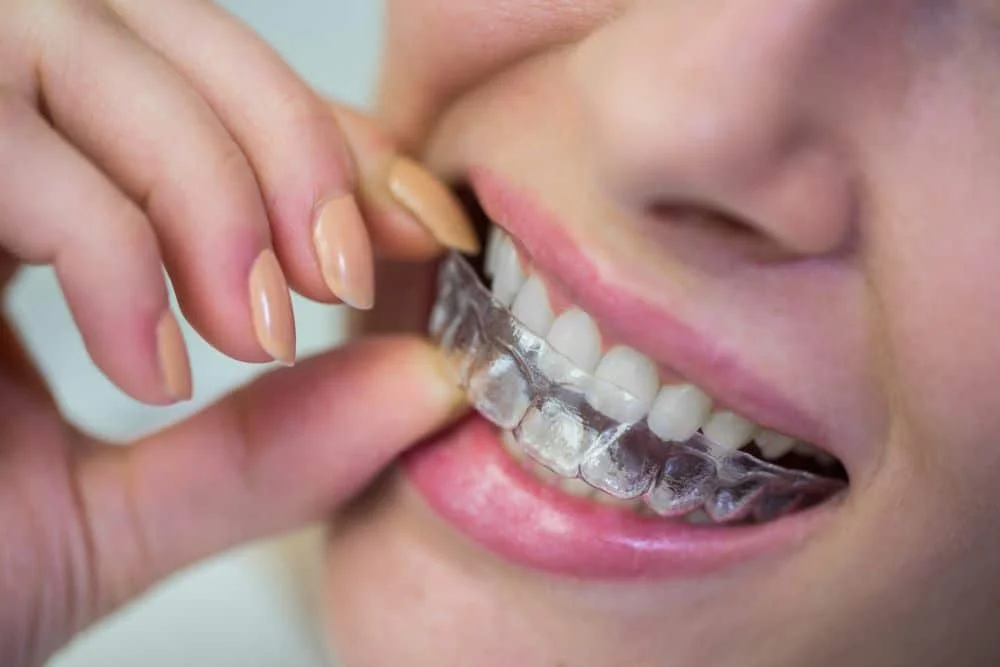 Read more about the article Invisalign vs Braces