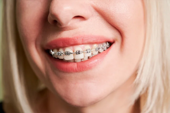 Read more about the article Damon Braces in Dubai | All You Need to Know