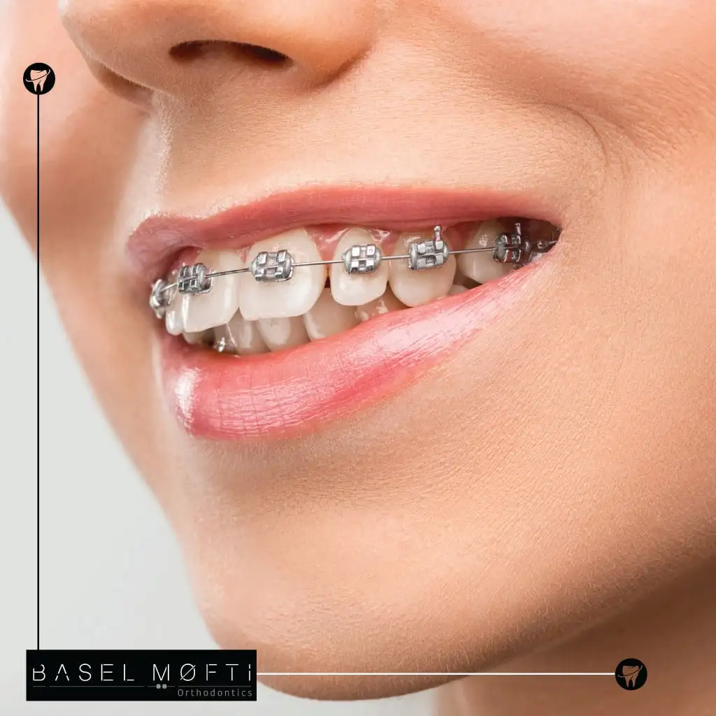 Traditional Metal Braces in Dubai