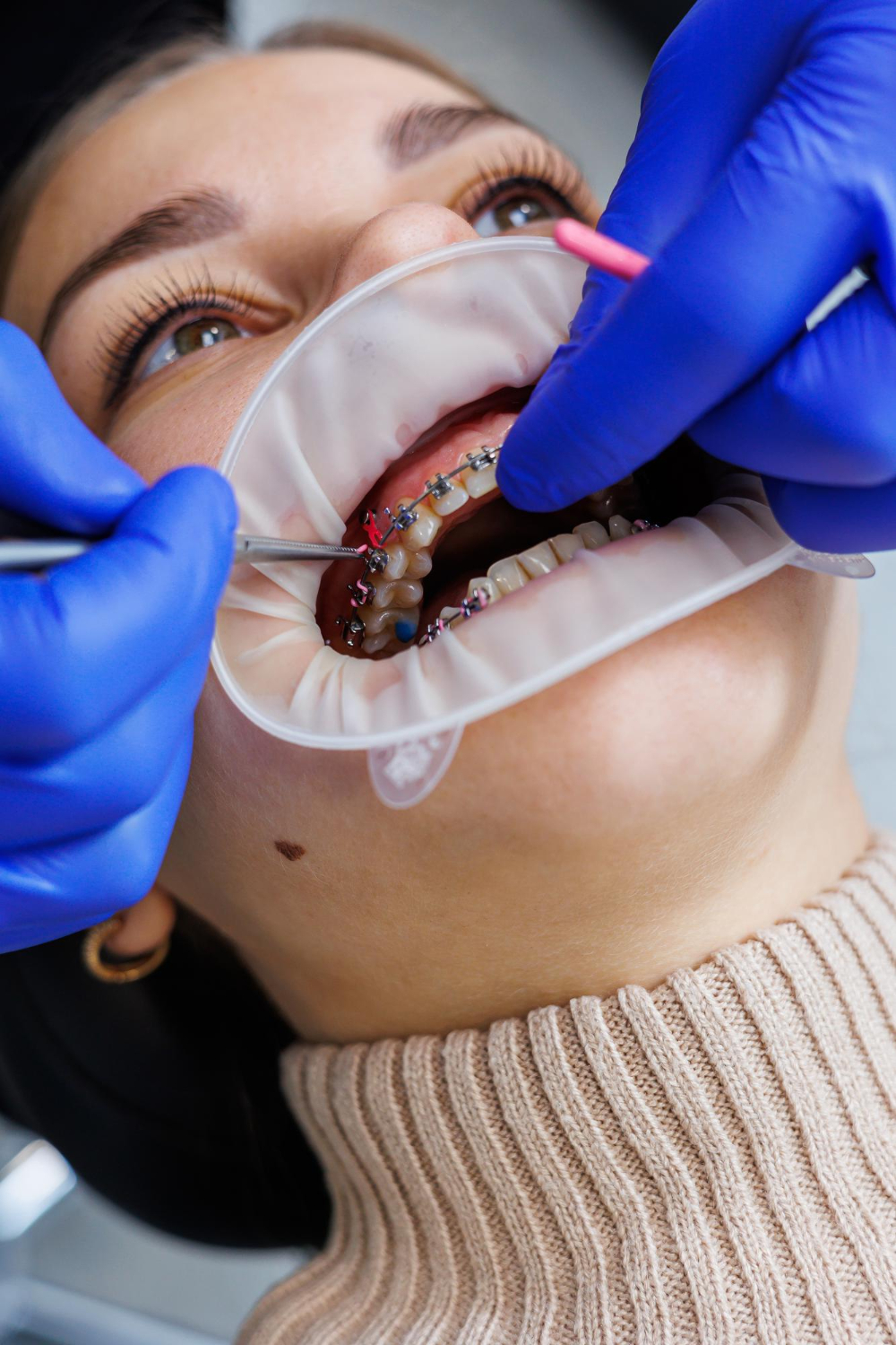 Dr. Basel Mofti for Crossbite Correction