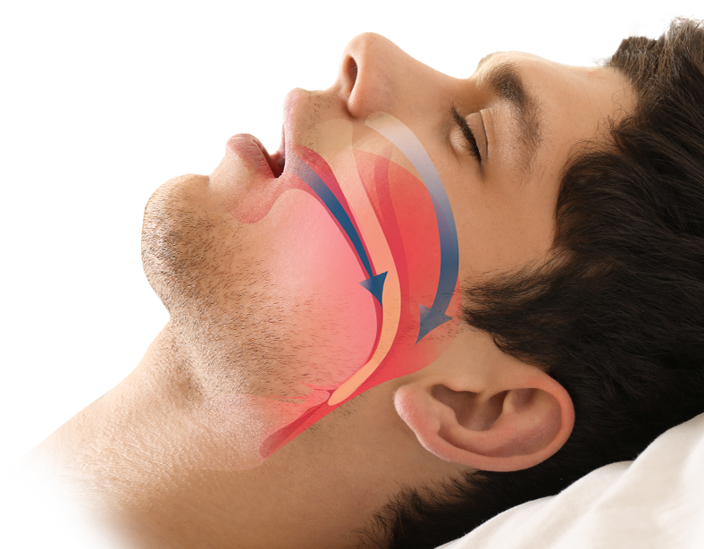 Dentists in Diagnosing Sleep Apnea