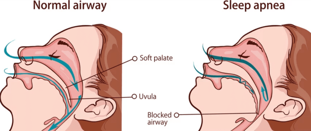 Is-Sleep-Apnea-A-Serious-Condition