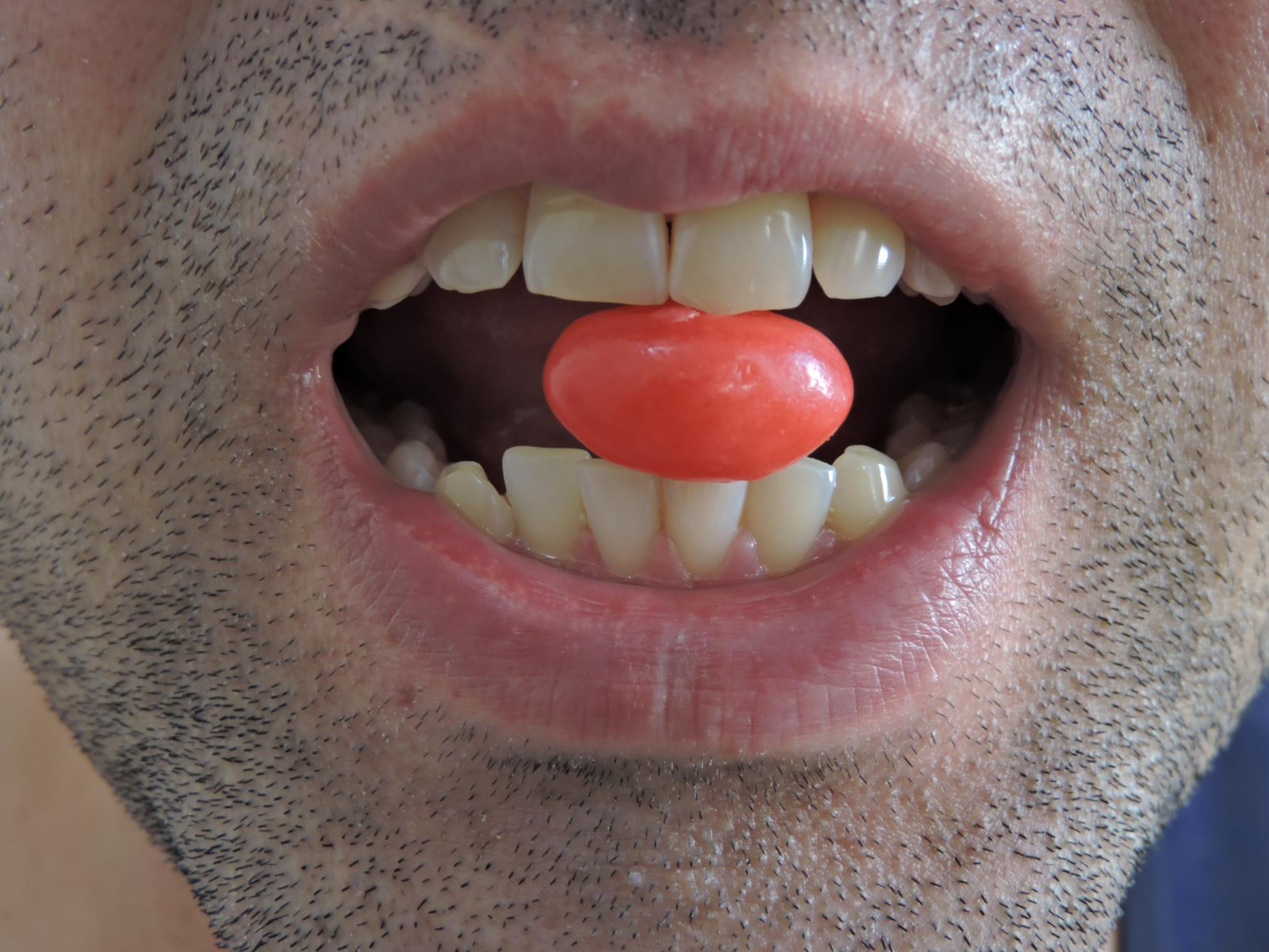 Why Choose Invisalign for Crossbite Correction