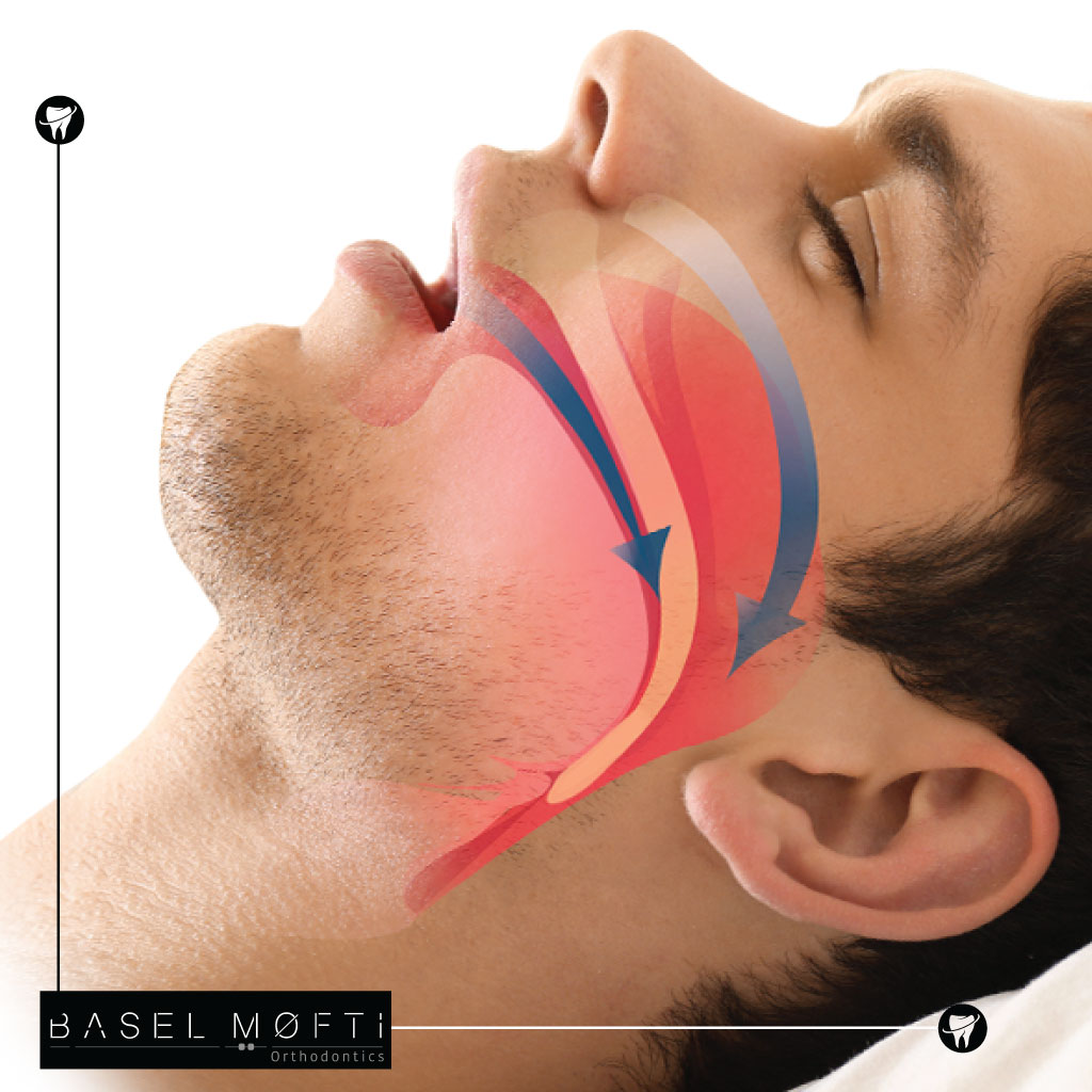 Orthodontics-in-Treating-Sleep-Apnea-and-Snoring