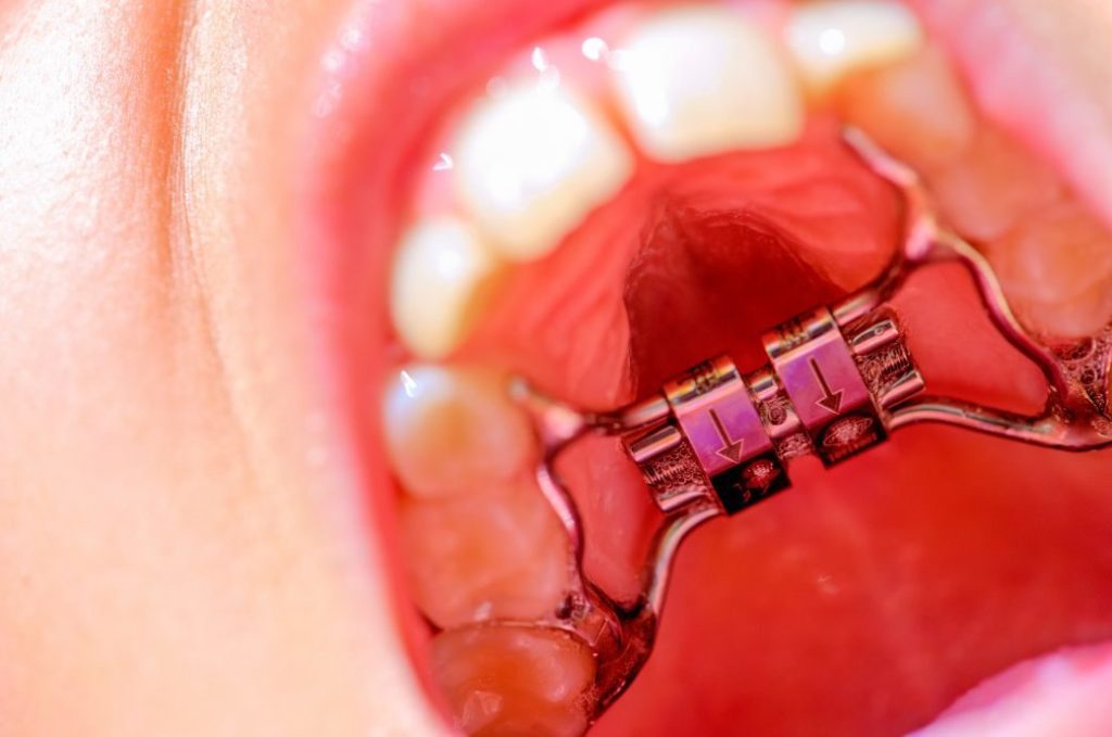 Transform Your Smile with MARPE in Dubai