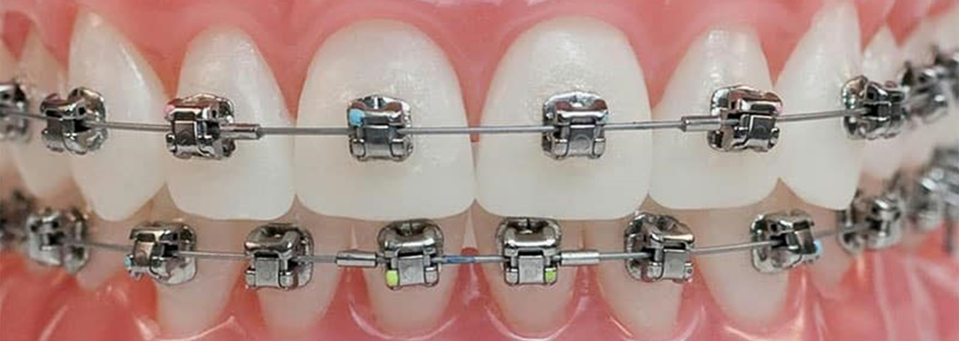 damon-braces-orthodontist Dubai