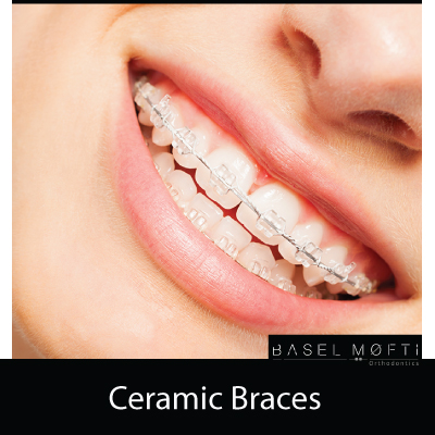 Ceramic-Braces--Orthodontist