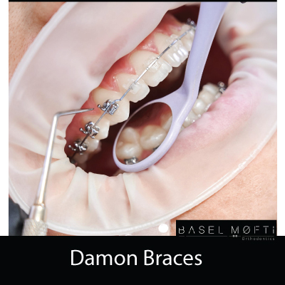 Damon-Braces--Orthodontist