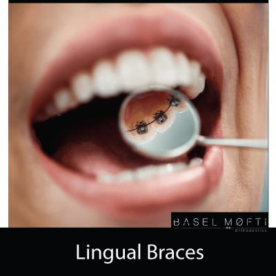 Lingual-Braces--Orthodontist