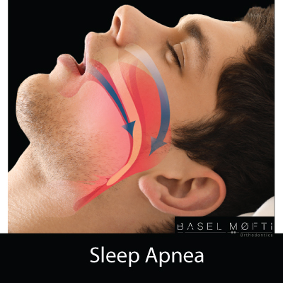 Sleep-Apnea---Orthodontist