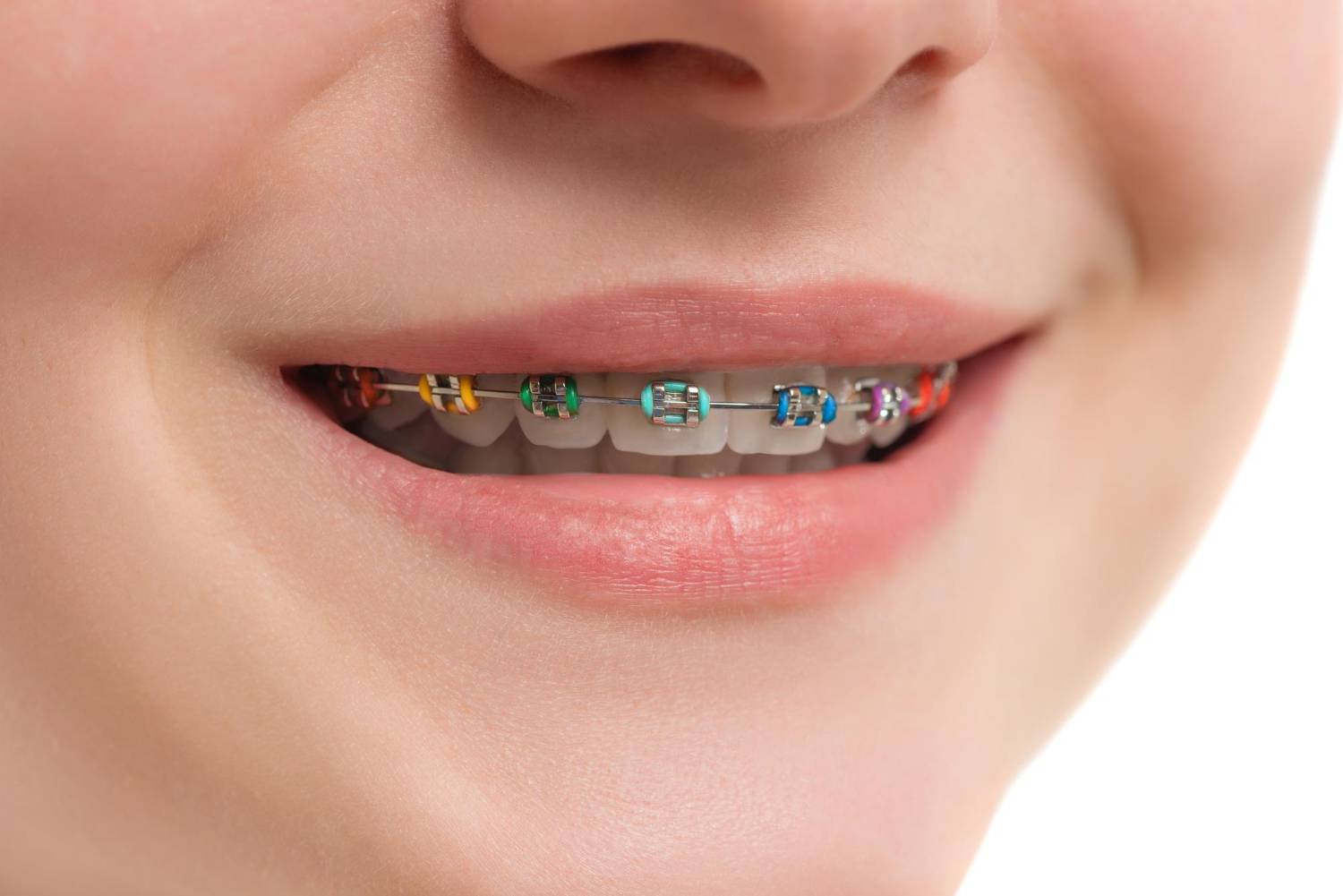 Read more about the article Dubai’s Trending Teeth Braces Colors for 2025 : The Best Braces Color for You