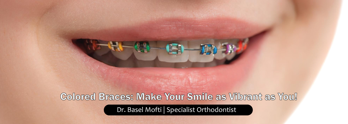 Colored-Braces-in-Dubai