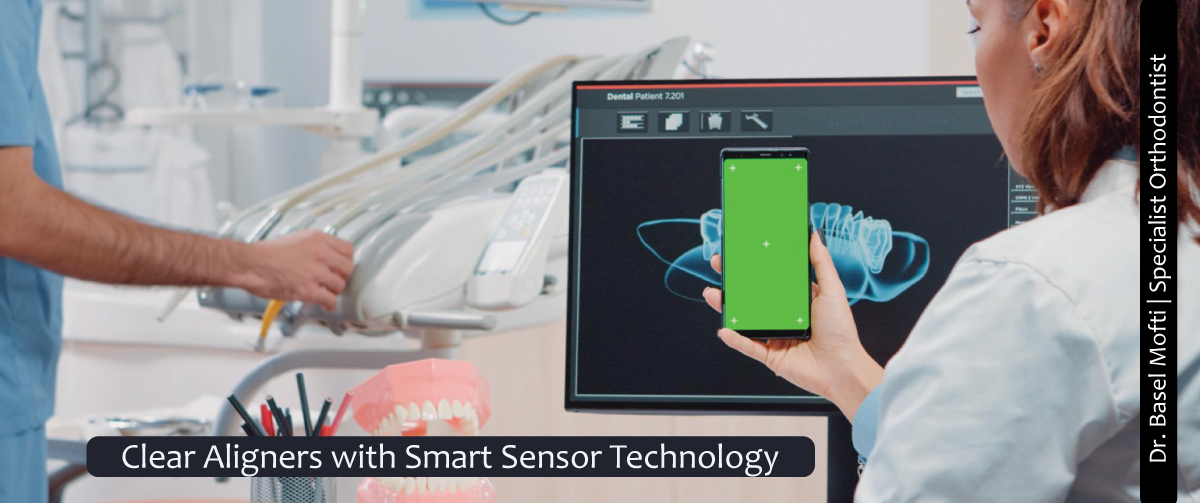 Clear-Aligners-with-Smart-Sensor-Technology