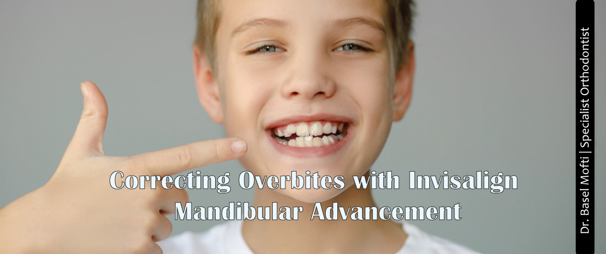 Correcting Overbites with Invisalign Mandibular Advancement
