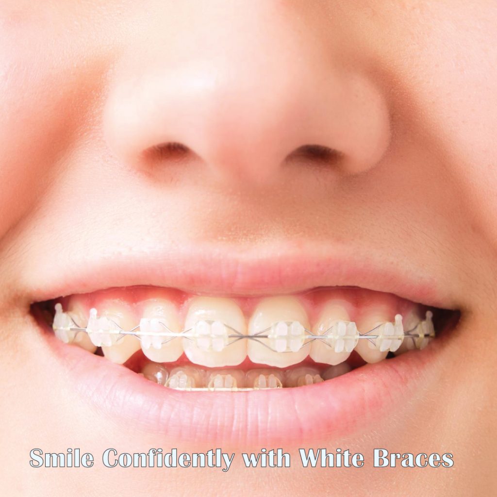 Smile-Confidently-with-White-Braces