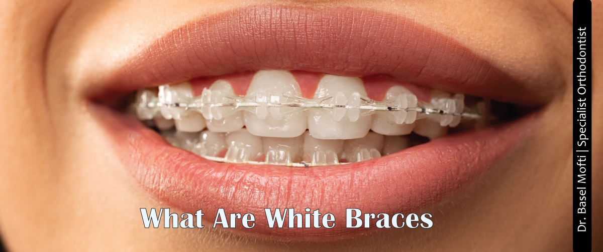 What-Are-White-Braces